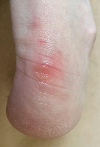 I discovered the hole after getting this big heel blister. Ouch!